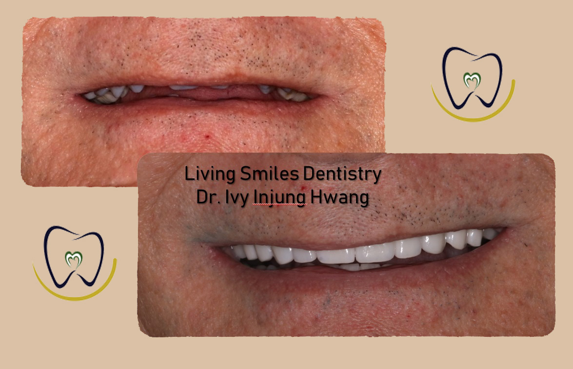 Dental Bridges in Livingston